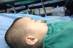 Bé trai bị chiếc đũa đâm sâu vào não do vô tình chọc qua mũi