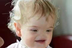 Cô bé 17 tháng tuổi không có mũi nhưng vẫn luôn nở nụ cười