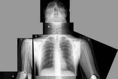 Phẫu thuật tái tạo hộp sọ bệnh nhân bằng công nghệ in 3D