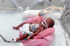 Bệnh nhi có cân nặng nhẹ nhất được phẫu thuật tim từ trước đến nay. (Ảnh: TTXVN phát)