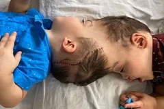 Bernardo và Arthur Lima (gần 4 tuổi) dính liền với nhau ở đầu, bao gồm một phần não, kể từ khi sinh ra.(Nguồn: PA)