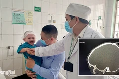 Đồng Nai: Cứu sống bé trai 2 tuổi bị đinh đâm qua xương sọ