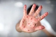 Lào phát hiện trường hợp mắc bệnh đậu mùa khỉ đầu tiên