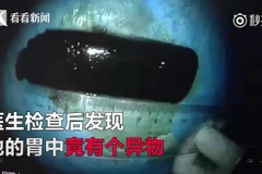 Chiếc bật lửa đã biến thành màu đen sau 2 thập kỷ nằm trong dạ dày của người đàn ông. (Nguồn: Medium)