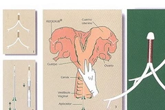Thiết bị tránh thai cho bò. (Nguồn: pergaminovirtual)