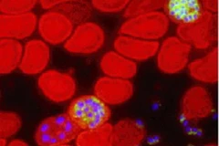 Các tế bào máu màu đỏ bị nhiễm ký sinh trùng gây bệnh sốt rét. (Nguồn: Internet)