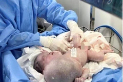 Bệnh nhi chào đời với một khối bướu vùng đầu cổ khổng lồ. (Ảnh: TTXVN phát)