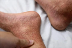 Biểu hiện lâm sàng của bệnh nhận sốt xuất huyết. (Ảnh: Minh Quyết/TTXVN)