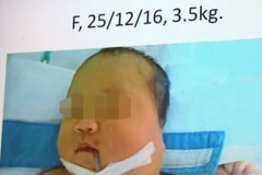Cắt bỏ khối bướu vùng cổ lan lên não ở bé gái 20 ngày tuổi