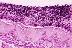 WHO lần đầu xác định bệnh nấm là mối đe dọa với sức khỏe con người