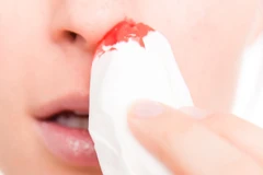 Lấy viên bi đồ chơi nằm sâu trong hốc mũi của bé trai 4 tuổi