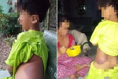 Long An: Kỷ luật cảnh cáo đối với cô giáo đánh học sinh bầm tím