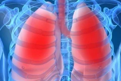 Ăn gì để giúp bạn tránh khỏi việc mắc bệnh phổi tắc nghẽn mãn tính