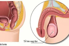 Dấu hiệu ung thư tinh hoàn.