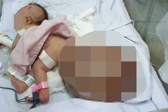 Phẫu thuật khối bướu nặng 3,1kg cho bé sơ sinh mới 1 ngày tuổi