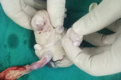 Phẫu thuật lấy khối u thai hiếm gặp trong bụng bé trai 4 tháng tuổi