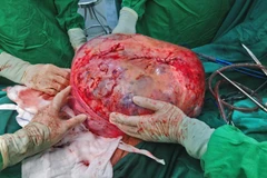 Khối u bồng trứng khổng lồ nặng 30kg sau khi đưa ra khỏi ổ bụng bệnh nhân 78 tuổi. (Ảnh: TTXVN)