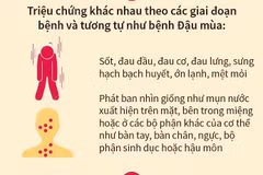 Bệnh Đậu mùa Khỉ: Triệu chứng và các biện pháp phòng bệnh