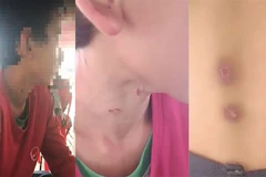 Em T. bị cha dượng bạo hành dã man. (Nguồn: Báo An Giang)