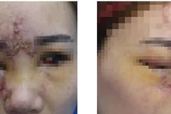 Một bệnh nhân bị tai biến do tiêm filler làm đẹp tại cơ sở không phép. (Nguồn: Vietnam+)