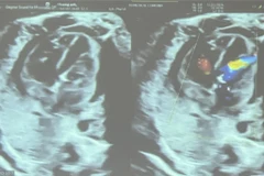 Siêu âm sau can thiệp tim mạch bào thai. (Ảnh: Đinh Hằng/TTXVN)