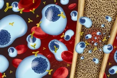 Bệnh đa u tủy xương gây ra do rối loạn tế bào plasma (màu xanh), hình thành các ổ tiêu xương. (Ảnh minh hoạ: Shutterstock)