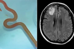 Australia: Phát hiện giun tròn sống ký sinh trong não người 