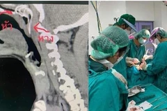 Thái Lan: Người đàn ông suýt chết vì bị cá rô nhảy vào cổ họng