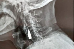 Người đàn ông sống với viên đạn găm vào cổ suốt 7 thập kỷ