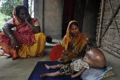 Bé gái Roona Begum tại nhà ở làng Jirania thuộc bang Tripura, đông bắc Ấn Độ ngày 13/4, trước khi phẫu thuật. (Nguồn: AFP/TTXVN)