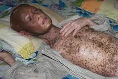 Bệnh nhân Điền bị bệnh dẫn đến bong tróc da. (Nguồn: Vnexpress)