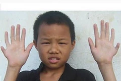 Cậu bé với bàn tay 12 ngón. (Nguồn: Internet)