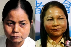 Chị Mai trước và sau phẫu thuật. (Nguồn: Vnexpress)