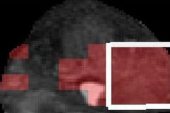 Một hình ảnh MRI của tuyến tiền liệt, với vùng màu đỏ thể hiện sự hiện diện của tế bào ung thư tuyến tiền liệt. (Nguồn: Internet)