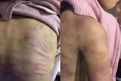 Các vết bầm tím trên người cháu B.