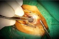 Hai người đàn ông sáng mắt nhờ được ghép giác mạc miễn phí