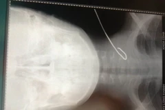 Cứu sống bé trai 11 tuổi bị cọng thép đâm thủng tĩnh mạch