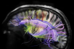 Lạm dụng thuốc tăng hoạt động não sẽ giảm sự phát triển não