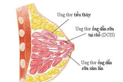 Các hóa chất hàng ngày tiềm ẩn nguy cơ gây ung thư vú