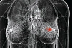 Xét nghiệm gen giúp thay đổi cách điều trị ung thư vú 