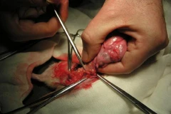 Cắt bỏ một phần bướu máu khổng lồ trên mặt cô gái 21 tuổi