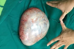 Khối u buồng trứng nặng 3,7kg được lấy ra sau khi phẫu thuật. (Ảnh: Trương Diệp/TTXVN)