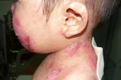 Cháu Nguyễn Việt Anh bị trượt da khắp người trước khi phẫu thuật. (Ảnh: PV/Vietnam+)