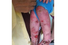 Bệnh nhân bị bệnh thượng bì bóng nước. (Ảnh: PV)