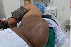 Hình ảnh khối u trước phẫu thuật. (Ảnh: TTXVN phát)