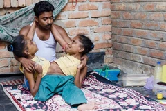 Hai chị em sinh đôi dính liền cùng yêu một người đàn ông