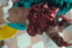 Học chế pháo trên YouTube, học sinh lớp 9 nhập viện do đa chấn thương