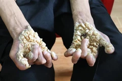 Căn bệnh khiến 2 tay anh Nguyễn Văn Sơn nổi những khối u khô ráp. (Ảnh: Đức Phương/TTXVN)