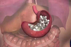 Indonesia bắt giữ đối tượng giấu 1kg ma túy trong dạ dày