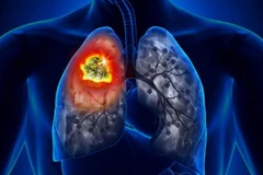 Google mô tả các kết quả ban đầu của AI mà nó phát triển để phát hiện ung thư phổi là đáng khích lệ. (Nguồn: newatlas)